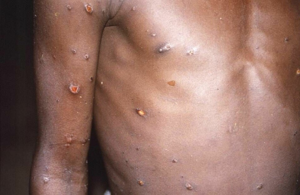Apkoppor ger upphov till utslag, sår och blåsor. Symtomen är ofta milda men kan bli allvarliga hos personer i riskgrupper. Arkivbild från Kongo-Kinshasa. Foto: AP/TT